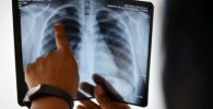 Universidades de Perú y EE.UU investigan detección temprana de la tuberculosis