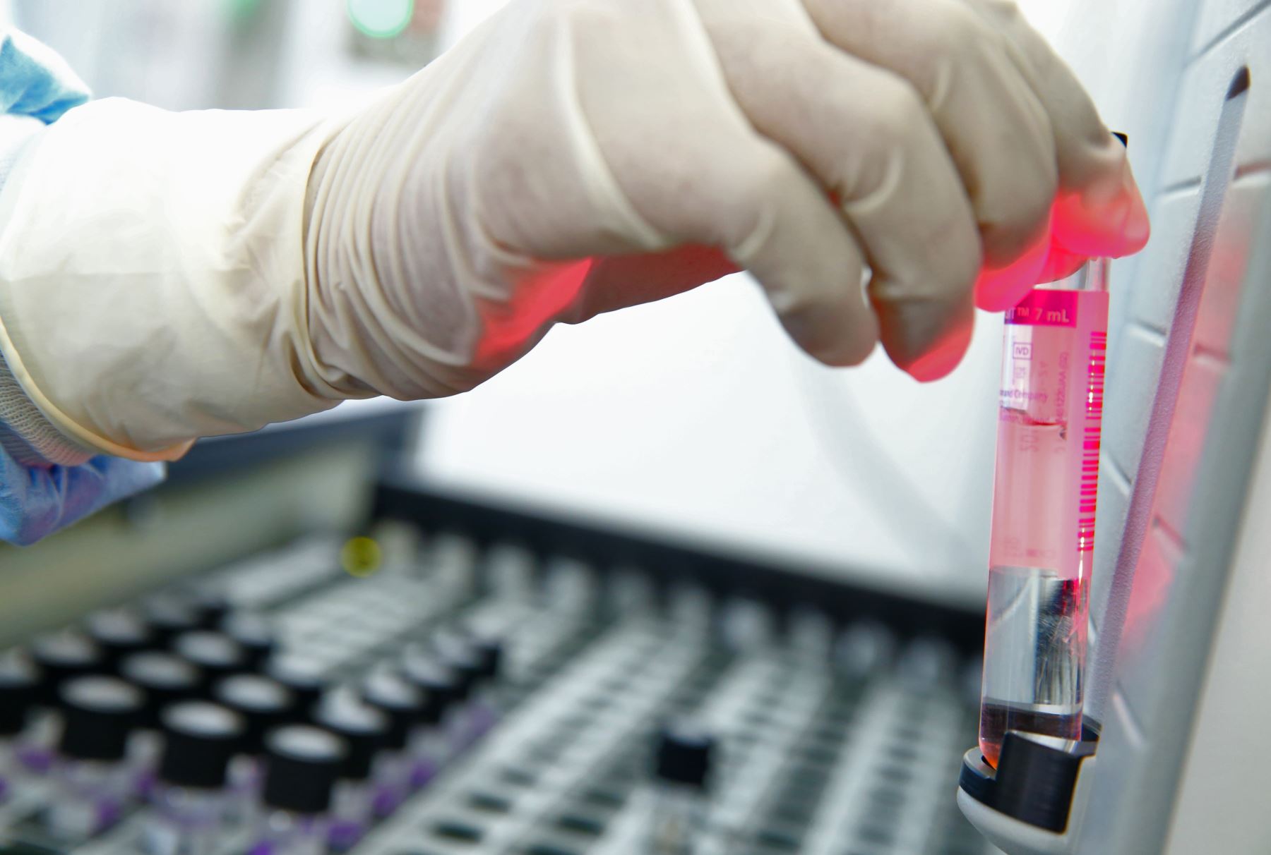 Universidades de Perú y EE.UU investigan detección temprana de la tuberculosis Universidades de Perú y EE.UU investigan detección temprana de la tuberculosis